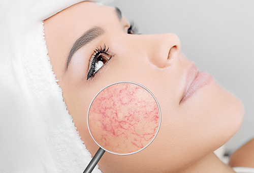 Broken Capillaries Treatment Melbourne Victorian Laser And Skin Clinic