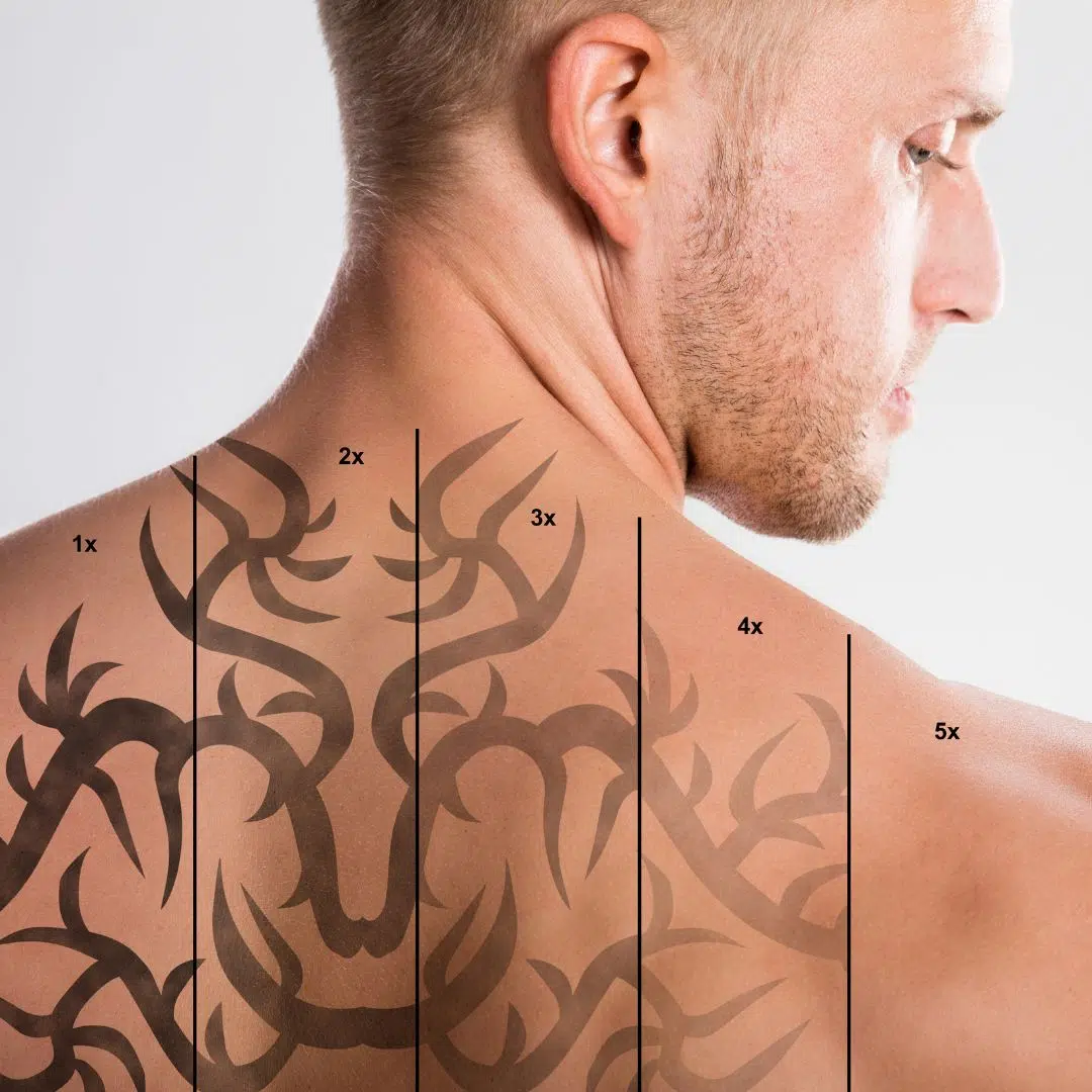 Laser Tattoo Removal Melbourne | Victorian Laser & Skin Clinic