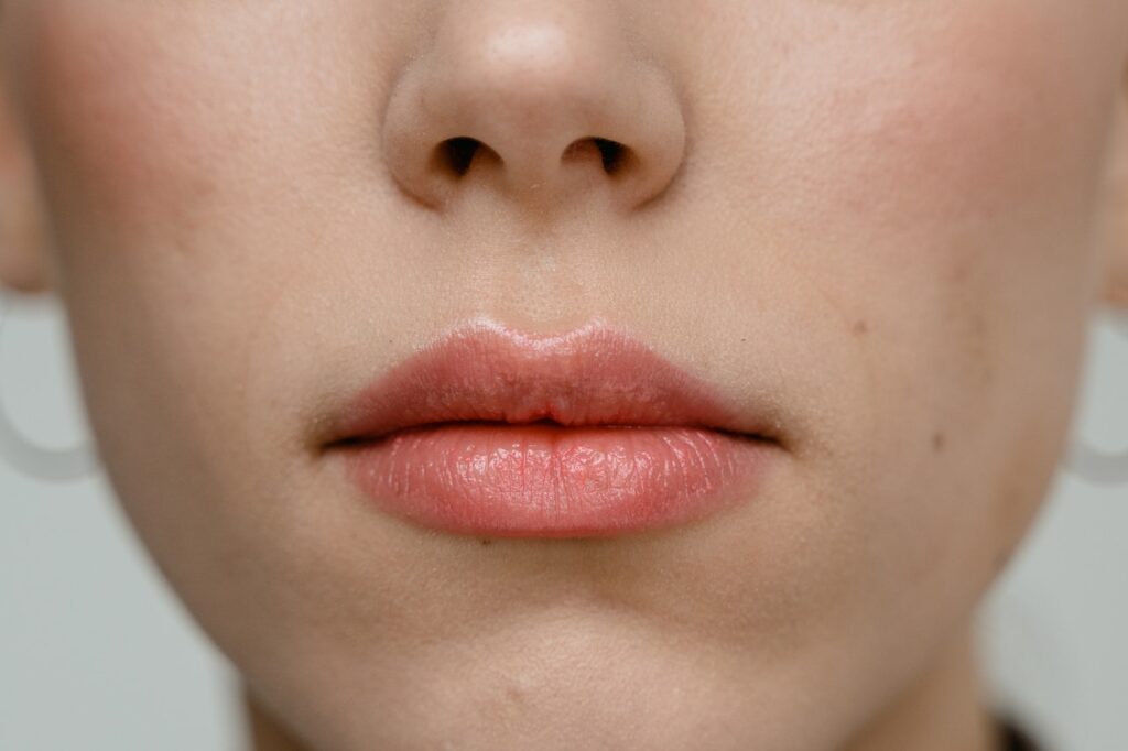 Russian Lip Fillers performed at Victoria Laser & Skin Clinic