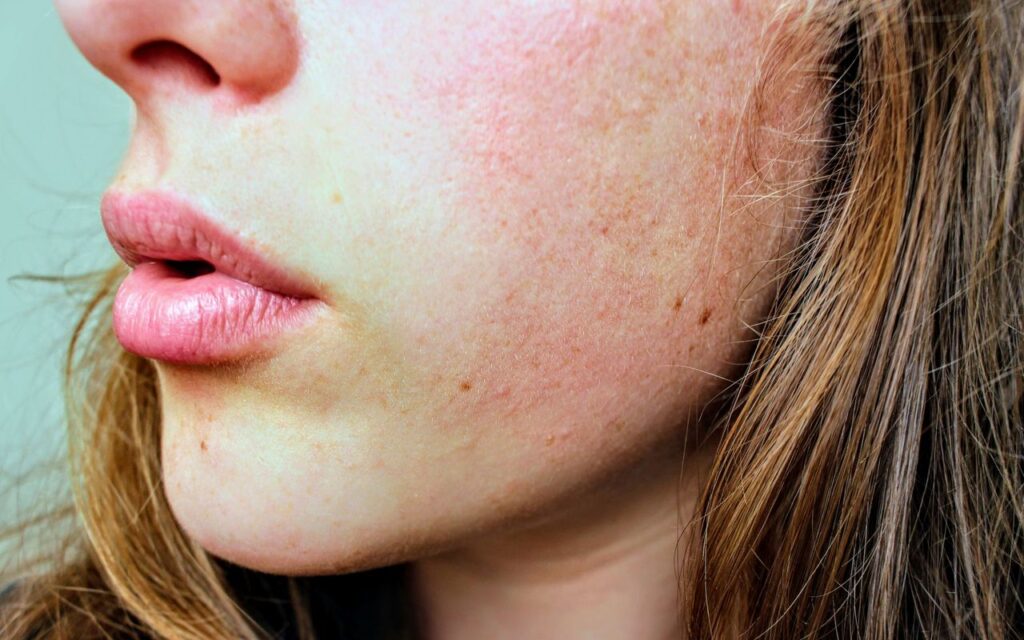 close up image of facial redness