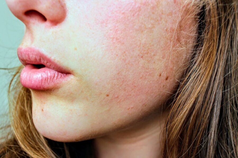 close up image of facial redness